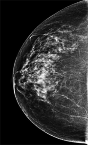 Slide13-digital-mammogram-most-common-density_180px.png