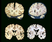 Brain_atrophyartwork_keene_june_myEmma-thumbnail.jpg